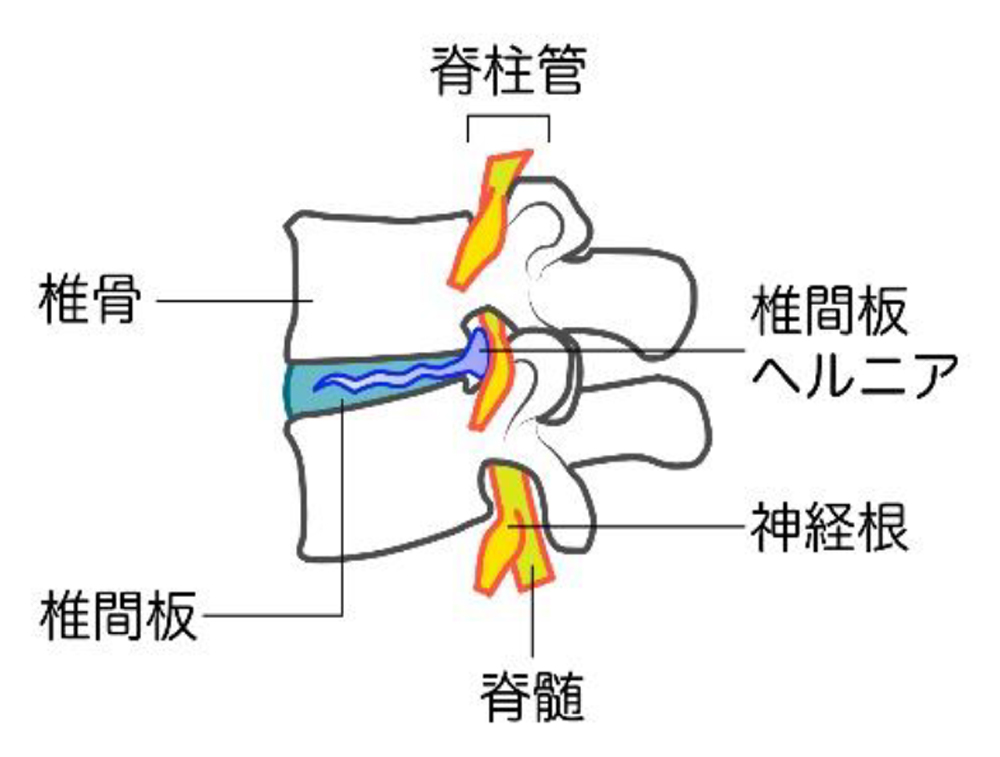 頸椎椎間板ヘルニア2