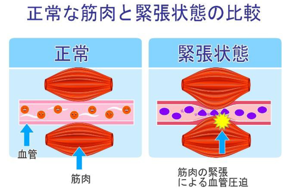 首の痛みの原因とは