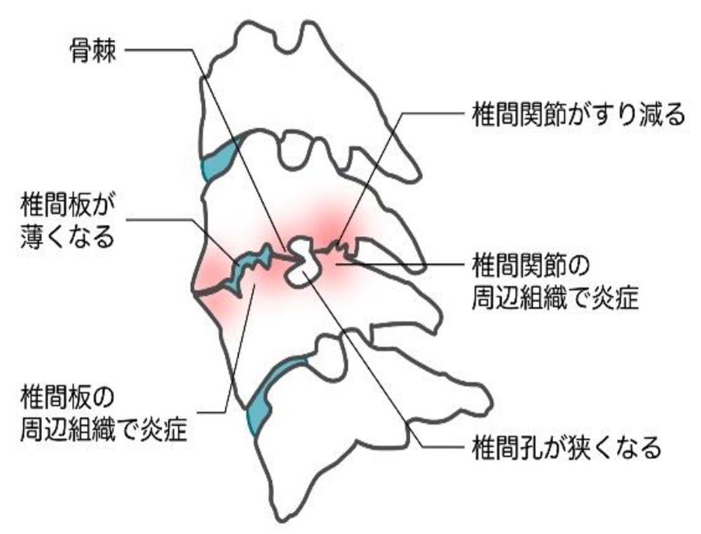 頚椎症性脊髄症