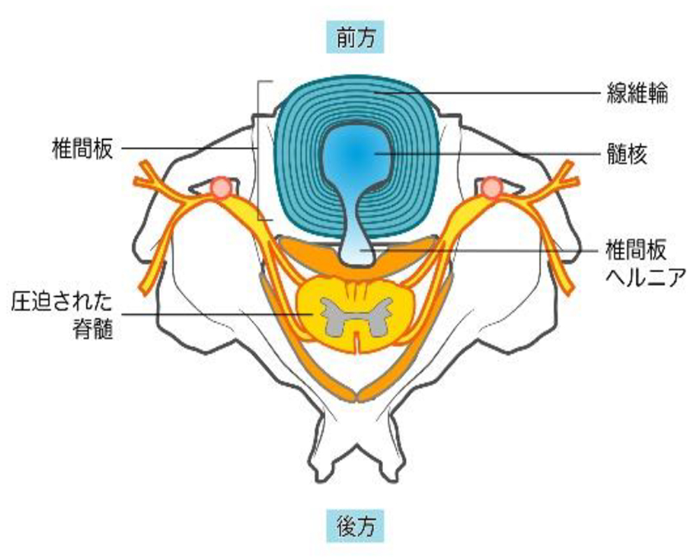 頸椎椎間板ヘルニア